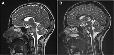 Unusual Presentation of Polyautoimmunity and Renal Tubular Acidosis in an Adolescent With Hashimoto's Thyroiditis and Central Pontine Myelinolysis